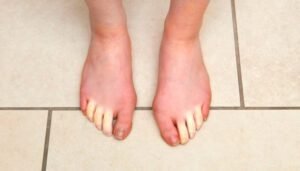 हाथ पैरों का सुन्न होने कारण और इलाज Causes and treatment of numbnessin hands and feet